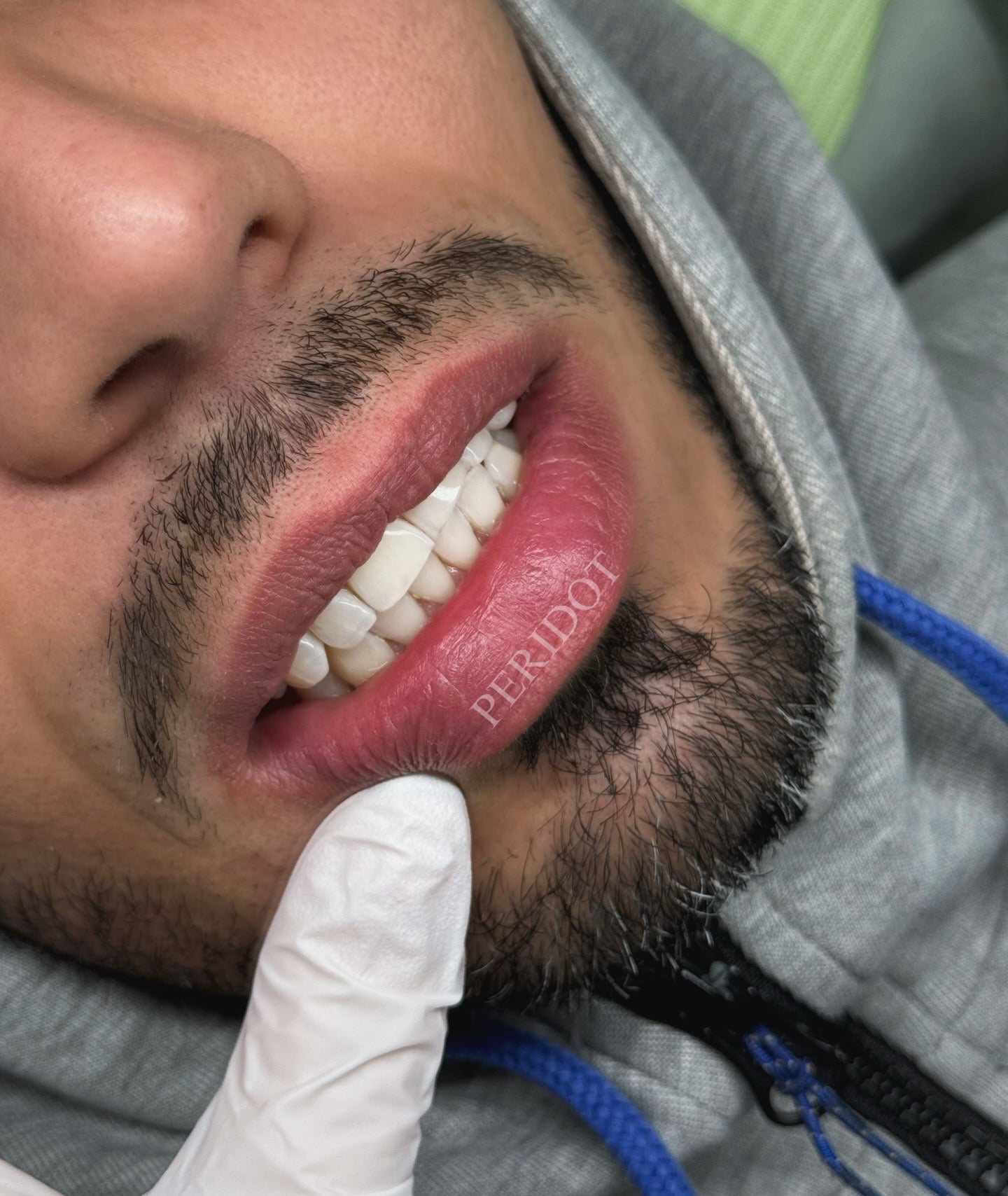 Teeth Bleaching (90MIN)