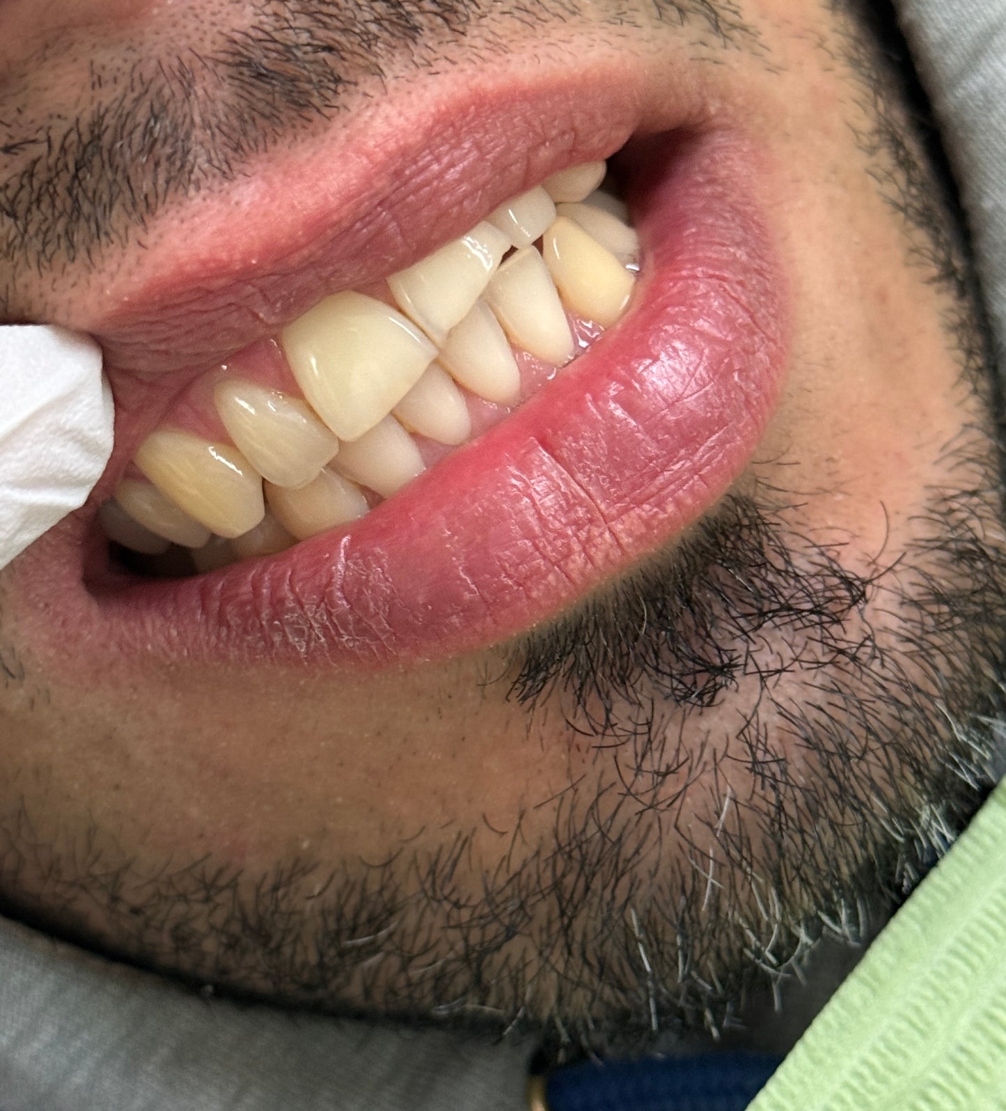 Teeth Bleaching (90MIN)